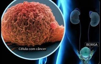 Boas práticas para prevenir o câncer de bexiga
