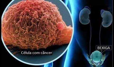Boas práticas para prevenir o câncer de bexiga