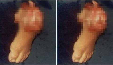 Mãe amputa o pé do filho de 3 anos com machado para receber seguro do INSS