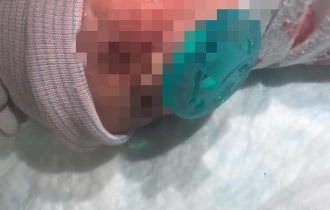 Bebê tem o rosto cortado durante cesárea e leva 13 pontos na bochecha