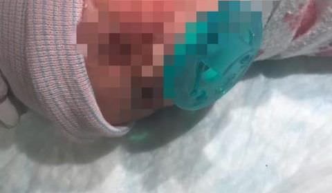 Bebê tem o rosto cortado durante cesárea e leva 13 pontos na bochecha