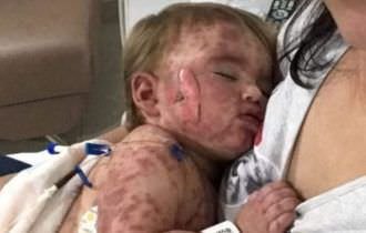 Medicamento deixa criança com o corpo coberto de queimadura