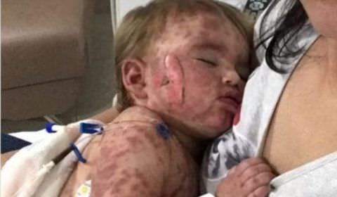 Medicamento deixa criança com o corpo coberto de queimadura