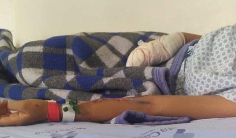 Menina tem dedos decepados ao brincar escondido de estourar 'bombinha'