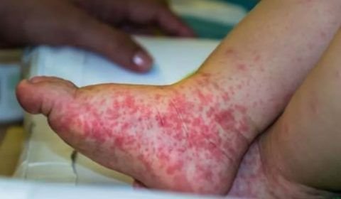 Surto de síndrome 'mão-pé-boca' em crianças acende alerta; conheça sintomas
