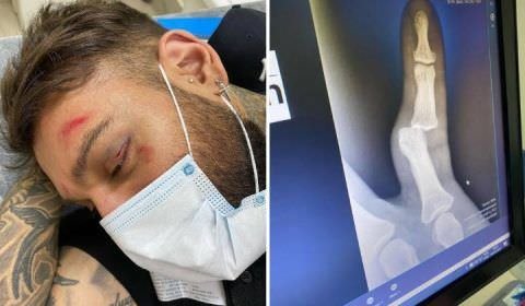 Lucas Lucco vai à hospital após acidente doméstico: 'Bebi demais'