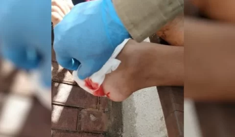 Ataque de piranhas: turista é mordido no pé e no joelho em lago