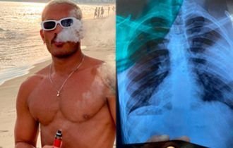 Manauara tem pulmão perfurado por uso de cigarro eletrônico; veja VÍDEO