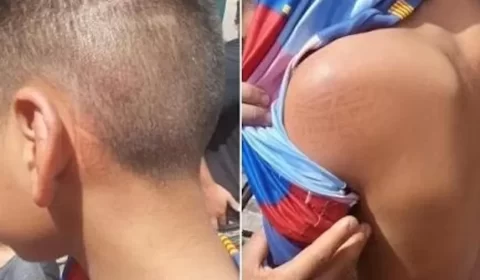 Família de adolescente agredido por assobiar abre vaquinha para tratamento