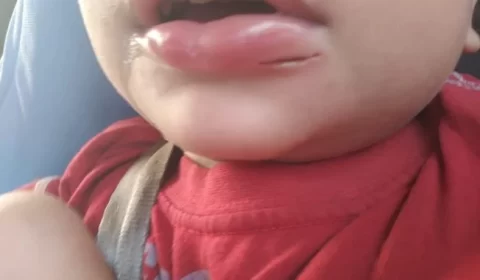criança perder oito dentes em creche