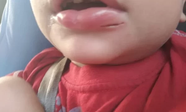 criança perder oito dentes em creche