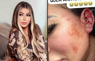 Influencer Milena Lins diz que foi agredida por namorado e posta fotos