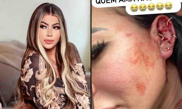 Influencer Milena Lins diz que foi agredida por namorado e posta fotos