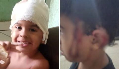Menino perde parte da orelha ao ser atacado por cadela enquanto passeava com a mãe