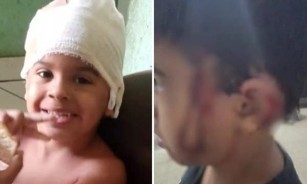 Menino perde parte da orelha ao ser atacado por cadela enquanto passeava com a mãe