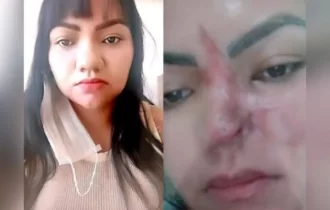 Mulher perde parte do nariz após cirurgia estética: “É assustador”