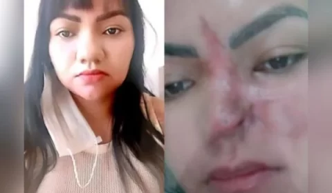 Mulher perde parte do nariz após cirurgia estética: “É assustador”