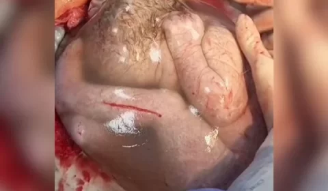 Médica compartilha vídeo em que gêmea nasce empelicada: “Mágico”