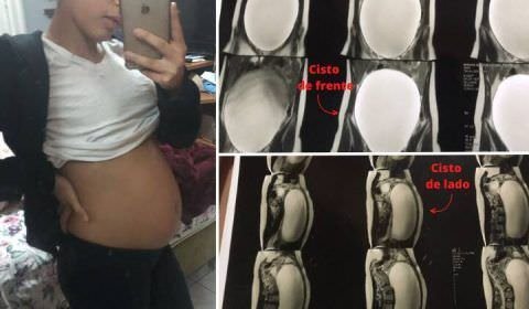 Jovem que removeu cisto de 7 kg do ovário lembra: 'Quase perdi minha vida'