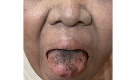 Mulher fica com a língua escura e peluda após tomar antibiótico