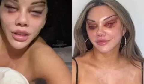 Mulher fica deformada após realizar cirurgia para ter “olhos de gata”