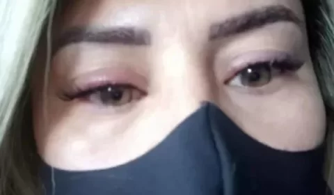 Mulher perde os cílios após colocar extensão: “Não crescem mais”