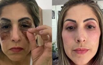 Mulher mostra rejuvenescimento do rosto 15 dias após fazer peeling de fenol e viraliza nas redes sociais