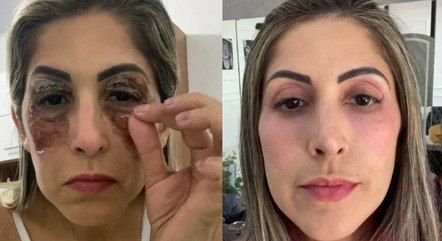 Mulher mostra rejuvenescimento do rosto 15 dias após fazer peeling de fenol e viraliza nas redes sociais