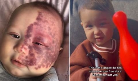 Após fazer procedimento a laser aos cinco meses, bebê não tem mais manchas no rosto