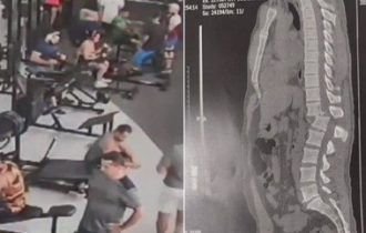Homem atingido por aparelho em academia consegue se sentar após cirurgia
