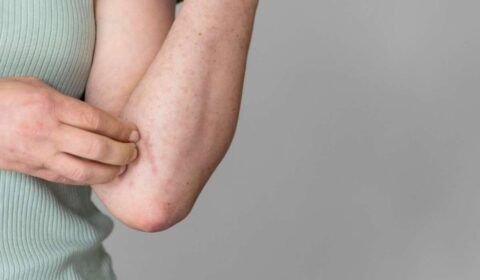 1_picada_de_mosquito__freepik-34527575