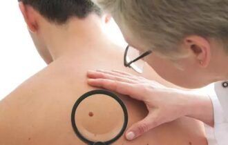 pessoas-devem-se-cuidar-contra-a-exposic-o-prolongada-aos-raios-solares-como-prevenc-o-ao-cancer-de-pele