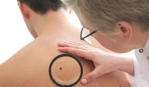 pessoas-devem-se-cuidar-contra-a-exposic-o-prolongada-aos-raios-solares-como-prevenc-o-ao-cancer-de-pele